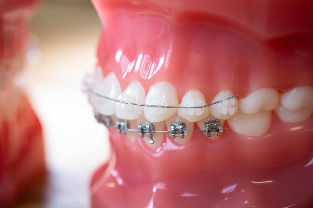 mbrace-orthodontics-falmouth-maine-orthodontic-office-orthodontic-technology-42-1024x683 Брекеты Clarity