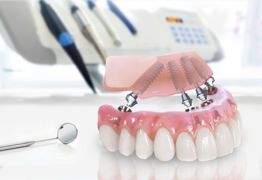 odnomomentnaja-implantacija-1-1024x704 Имплантация all on 4